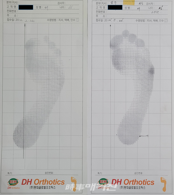 [샘플] 2014년 2월부터 2014년 7월까지 약 5개월간 DH오쏘틱스를 착용한 66세 여성의 발 개선 모습
