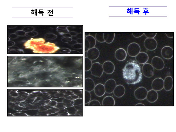 해독 전과 해독 후의 생혈구 차이(사진_소우주요양병원)